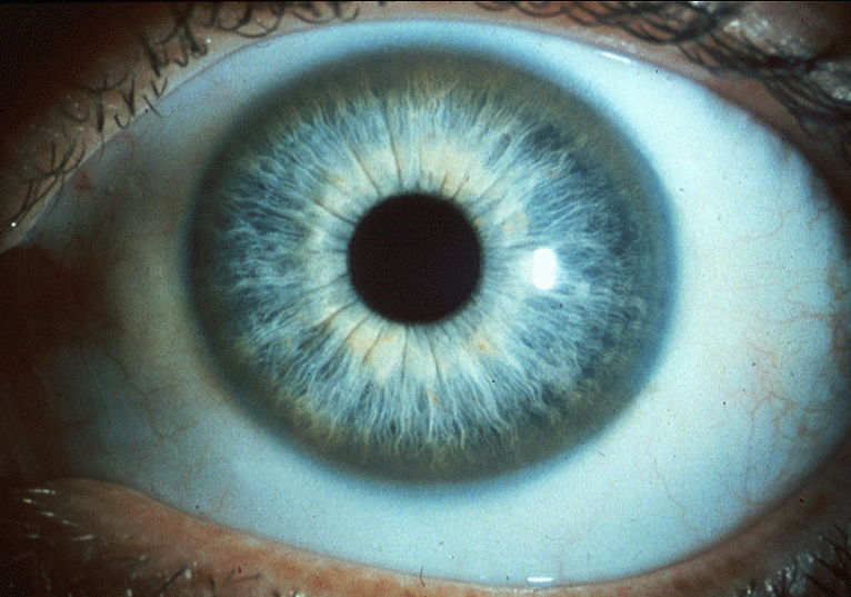 Tangents Wilson's Disease